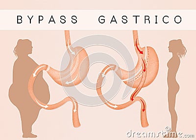 Gastric bypass to reduce stomach Stock Photo