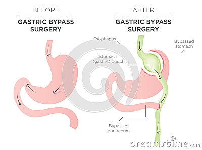 Gastric Bypass for Weight Loss Vector Illustration