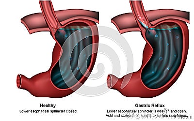 Gastric reflux 3d medical illustration with english description Cartoon Illustration