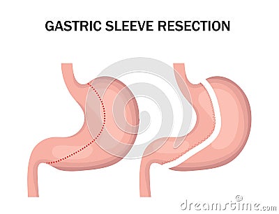 Gastric sleeve resection infographic. Stomach reduction surgery for weight loss. Medicine concept. Vector illustration Vector Illustration