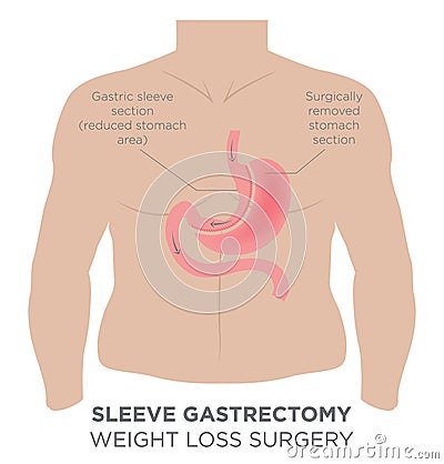 Gastric Sleeve Weight Loss Surgery Vector Illustration