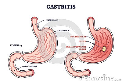 Gastritis as stomach lining inflammation illness and disease outline diagram Vector Illustration