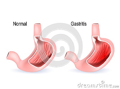 Gastritis. Cross section of two stomach Vector Illustration