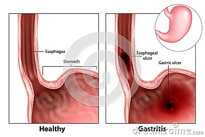Gastritis and Esophageal ulcer Vector Illustration