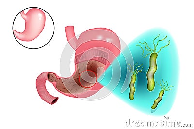 Gastritis Helicobacter pylori Vector Illustration