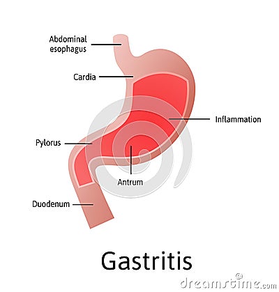 Gastritis, an inflammation, irritation, or erosion of the lining of the stomach. Medical vector illustration marked with Vector Illustration