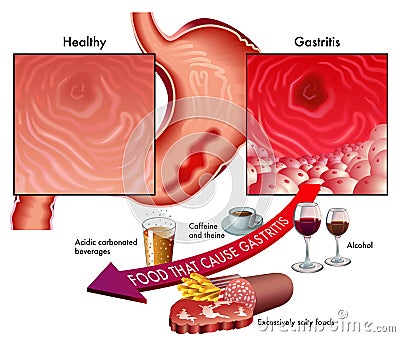 Gastritis Vector Illustration