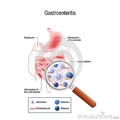 Gastroenteritis Vector Illustration