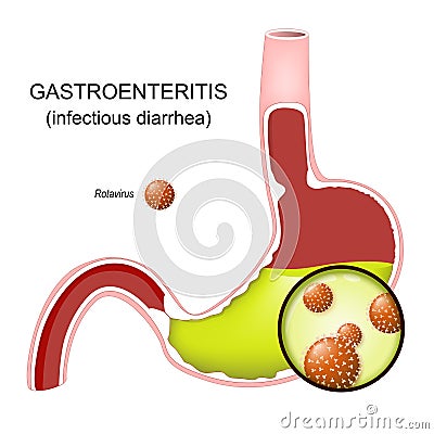 Gastroenteritis. Stomach flu or Infectious diarrhea Vector Illustration