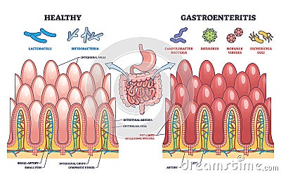 Gastroenteritis or stomach flu microbiological explanation outline diagram Vector Illustration