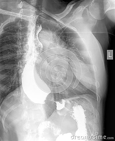 Gastroesofageal examination xray barrium swallow Stock Photo