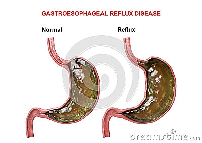 Gastroesophageal Reflux Disease - failure of the digestive mechanism sphincter that causes passage of gastric acid into the Cartoon Illustration