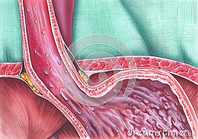 Gastroesophageal Reflux Disease Stock Photo