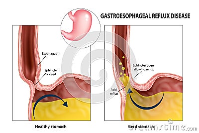 Gastroesophageal reflux disease Vector Illustration