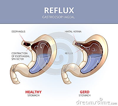 Gastroesophageal reflux disease. Healthy and sick Vector Illustration