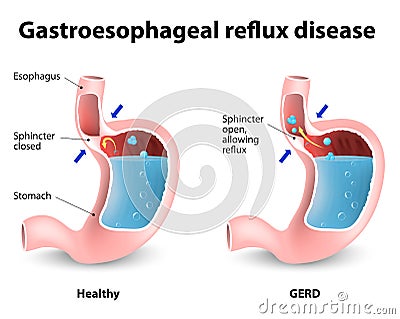 Gastroesophageal Reflux Disease Vector Illustration