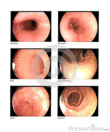 Gastrointestinal endoscopic examination Finding esophagus EG junction body cardia with fundus antrum duodenum normal contains Stock Photo