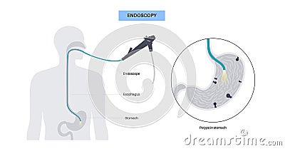 Gastroscopy endoscopy procedure Vector Illustration