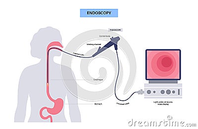 Gastroscopy endoscopy procedure Vector Illustration