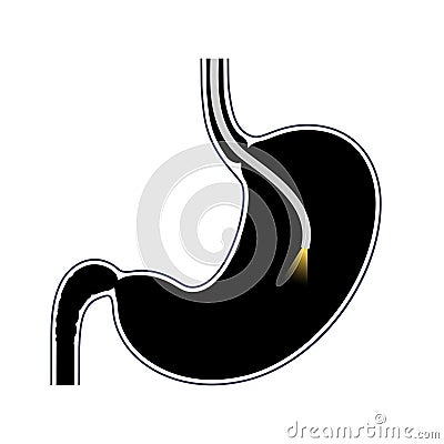 Gastroscopy endoscopy procedure Vector Illustration