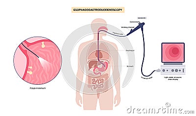 Gastroscopy endoscopy procedure Vector Illustration