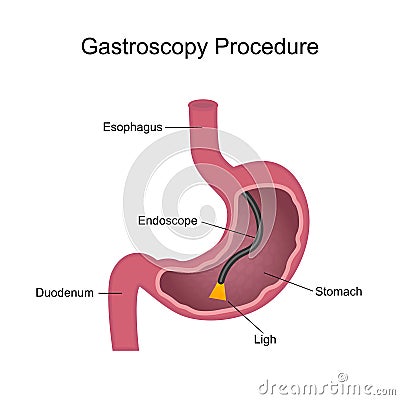 Gastroscopy Procedure Diagram Vector Illustration