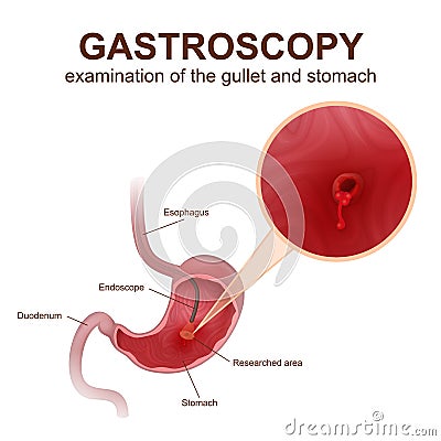 Gastroscopy procedure EGD Vector Illustration