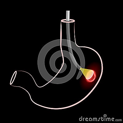 Gastroscopy procedure. Human stomach with Peptic ulcer, and endoscopic device Vector Illustration