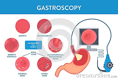 Gastroscopy procedure of stomach examination with endoscope Vector Illustration