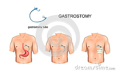 Gastrostomy tube. surgery Vector Illustration