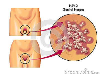 Genital herpes Vector Illustration