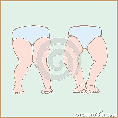 Genu varum, genu valgum - a physical legs deformity Vector Illustration