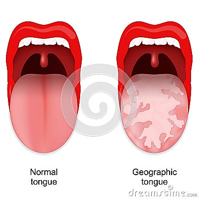 Geographic tongue. Benign migratory glossitis Vector Illustration