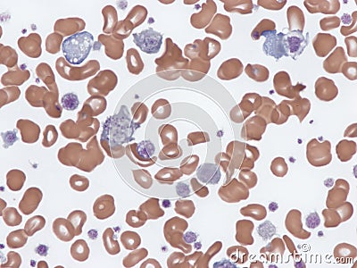 Giant platelets in peripheral blood. Stock Photo