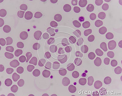 Giant platlet on red blood cells Stock Photo