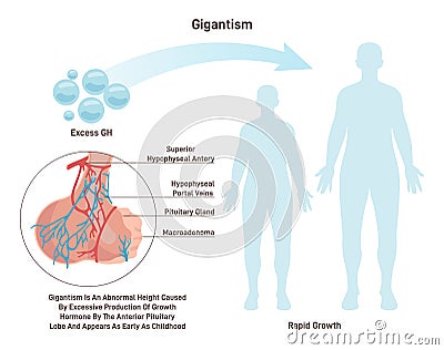 Gigantism. Syndrome characterized by excessive secretion of growth Vector Illustration