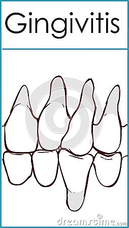 Gingivitis. Inflammation of the gums. Vector Illustration