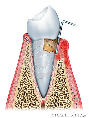 Gingivitis in its second stage Stock Photo