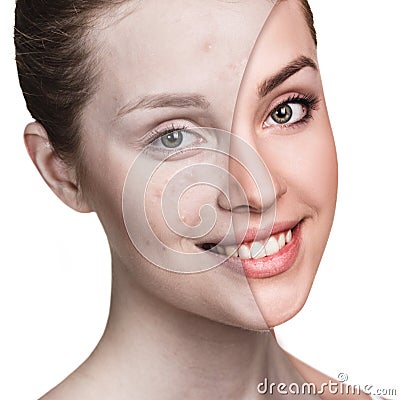 Girl with acne before and after treatment Stock Photo