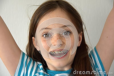 Girl with dental braces Stock Photo