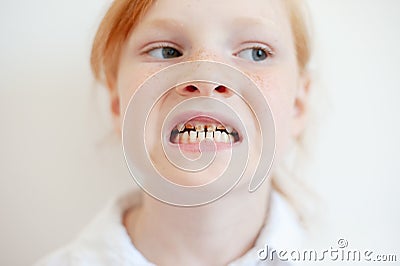 A girl with dental caries Stock Photo