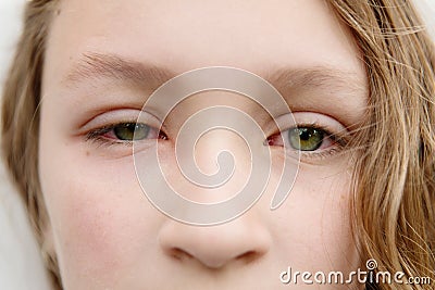 Girl with eye infection Stock Photo