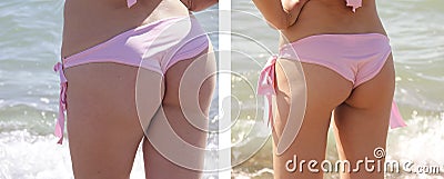 Girl figure in a swimsuit slimming cellulite he alth loss oversize before and after the diet fitness Stock Photo