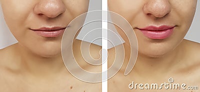 Girl lips increase before and after Stock Photo