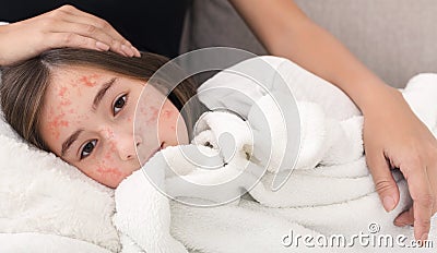 Girl With Measles Virus Lying On Mother Knees Stock Photo