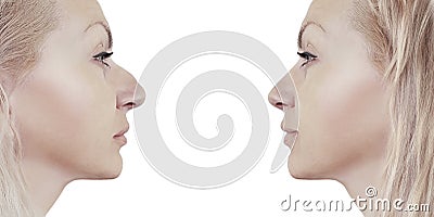 Girl nose before and after correction Stock Photo