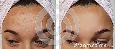 Girl pimples on the forehead before and after procedures Stock Photo