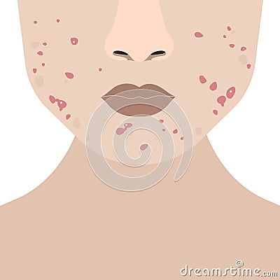 Girl with problematic skin Vector Illustration
