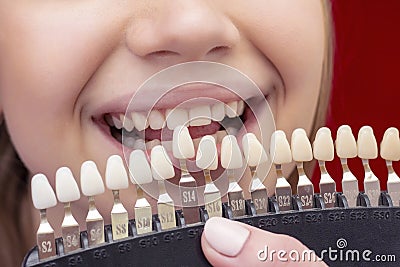 Girl on teeth whitening procedure with open mouth Stock Photo