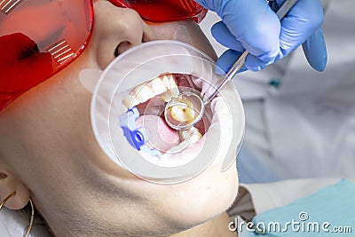 Girl at the reception at the dentist. treatment of carious tooth. on top of your teeth caries Stock Photo